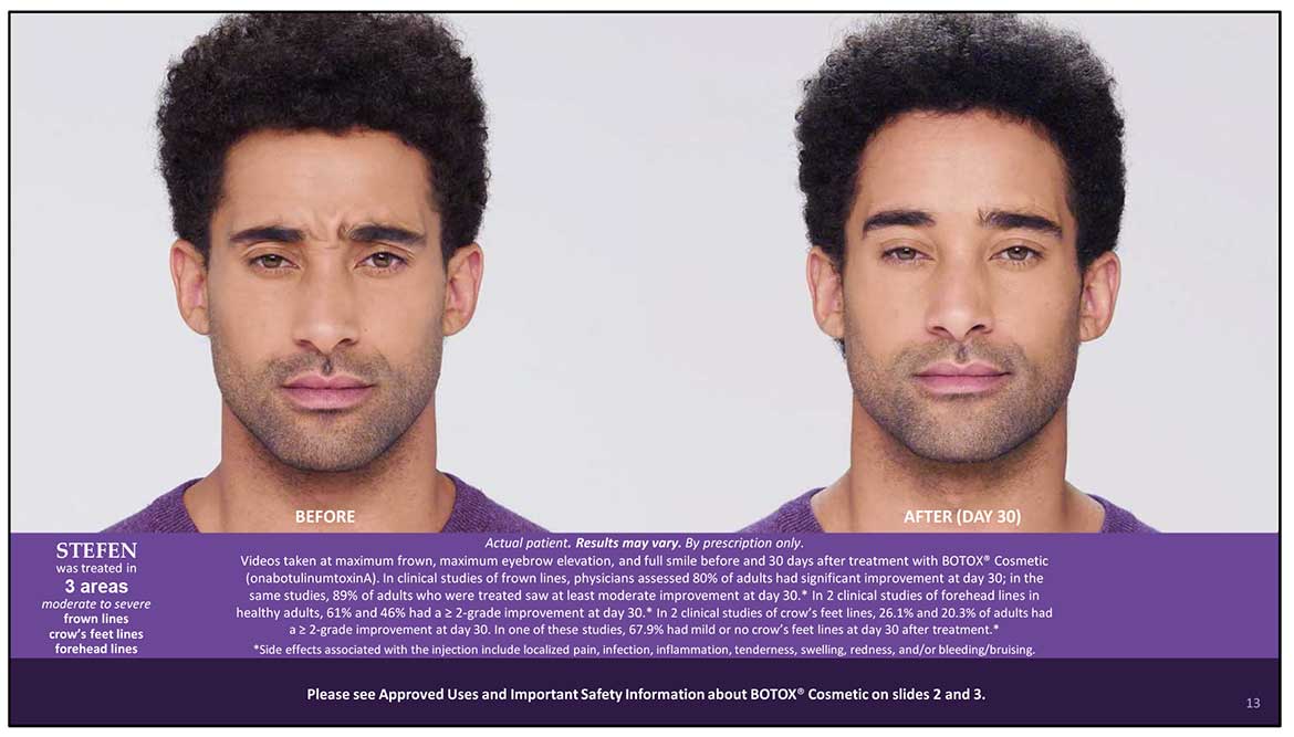 Botox Cosmetic Before and After Photos | Kingstoncosmetic.com