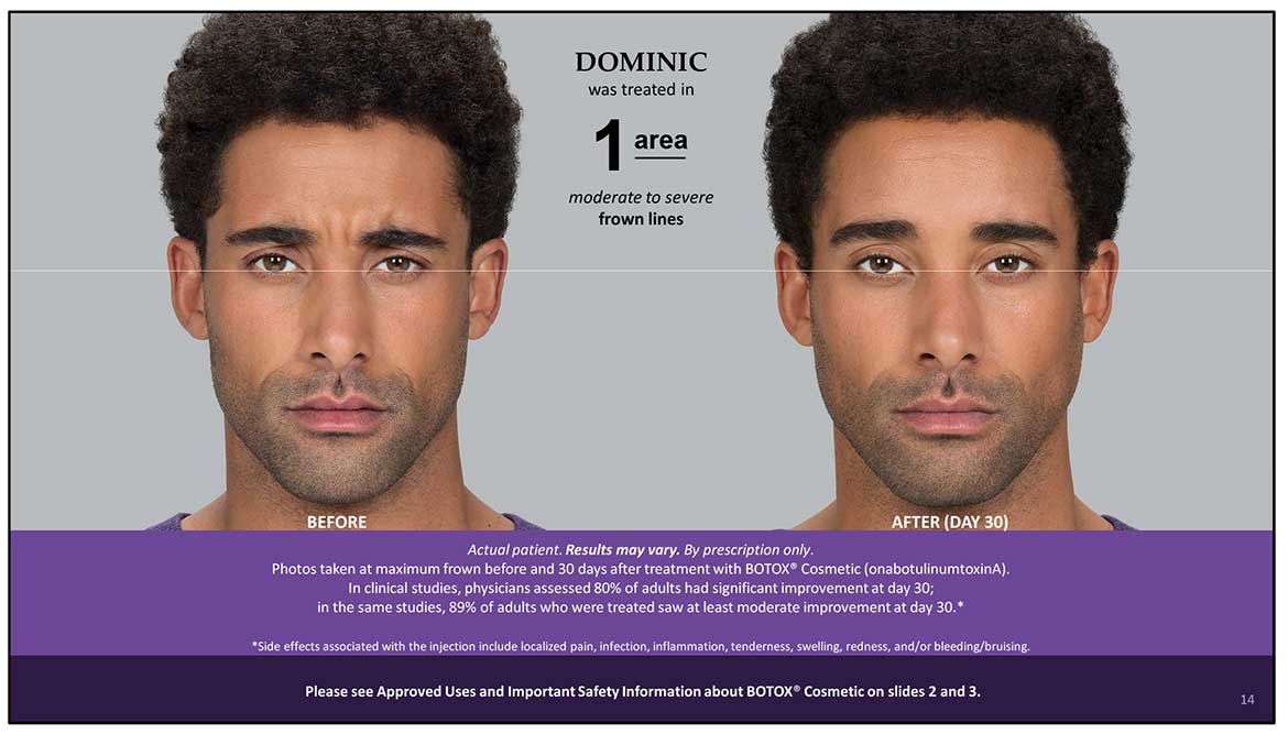 Botox Cosmetic Before and After Photos | Kingstoncosmetic.com