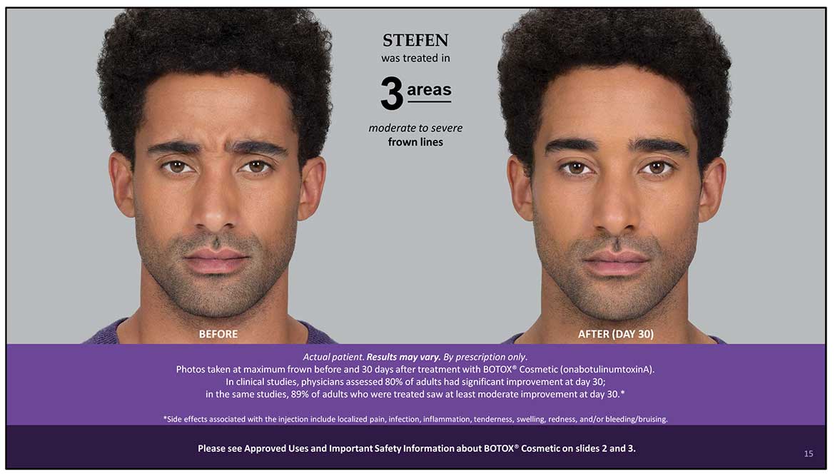 Botox Cosmetic Before and After Photos | Kingstoncosmetic.com