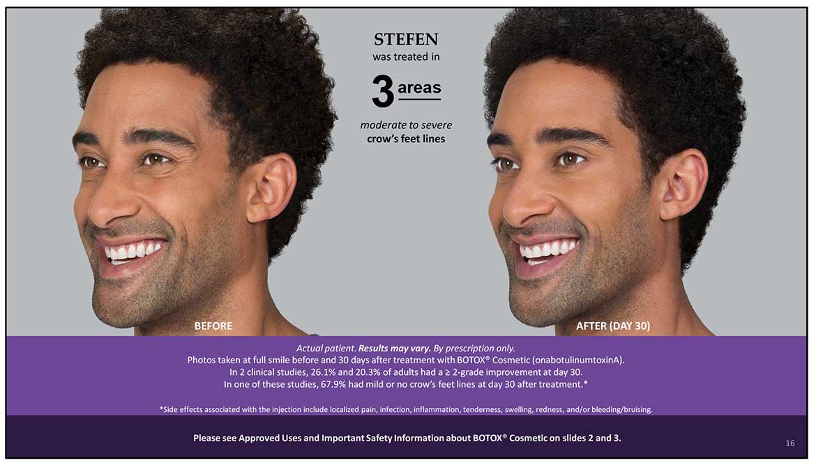 Botox Cosmetic Before and After Photos | Kingstoncosmetic.com