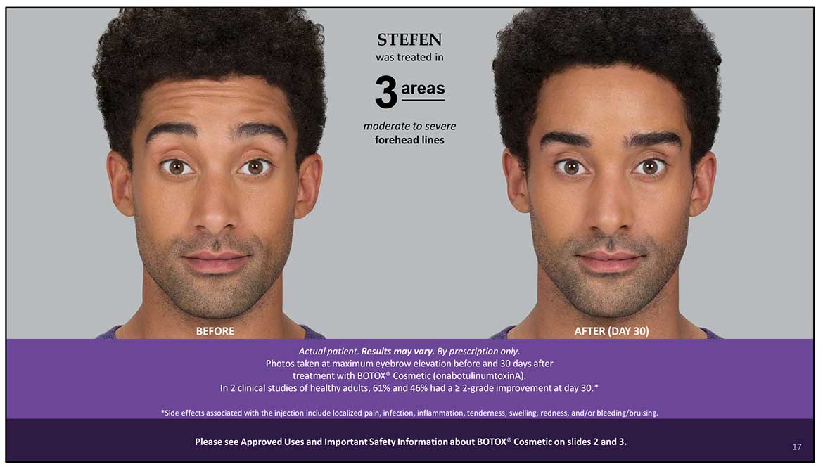 Botox Cosmetic Before and After Photos | Kingstoncosmetic.com