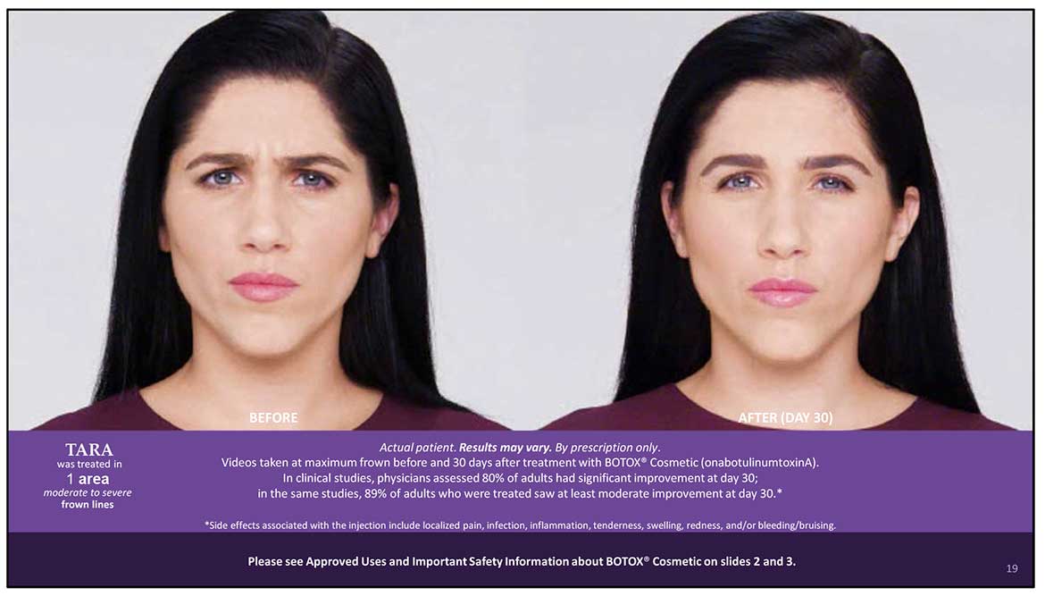 Botox Cosmetic Before and After Photos | Kingstoncosmetic.com
