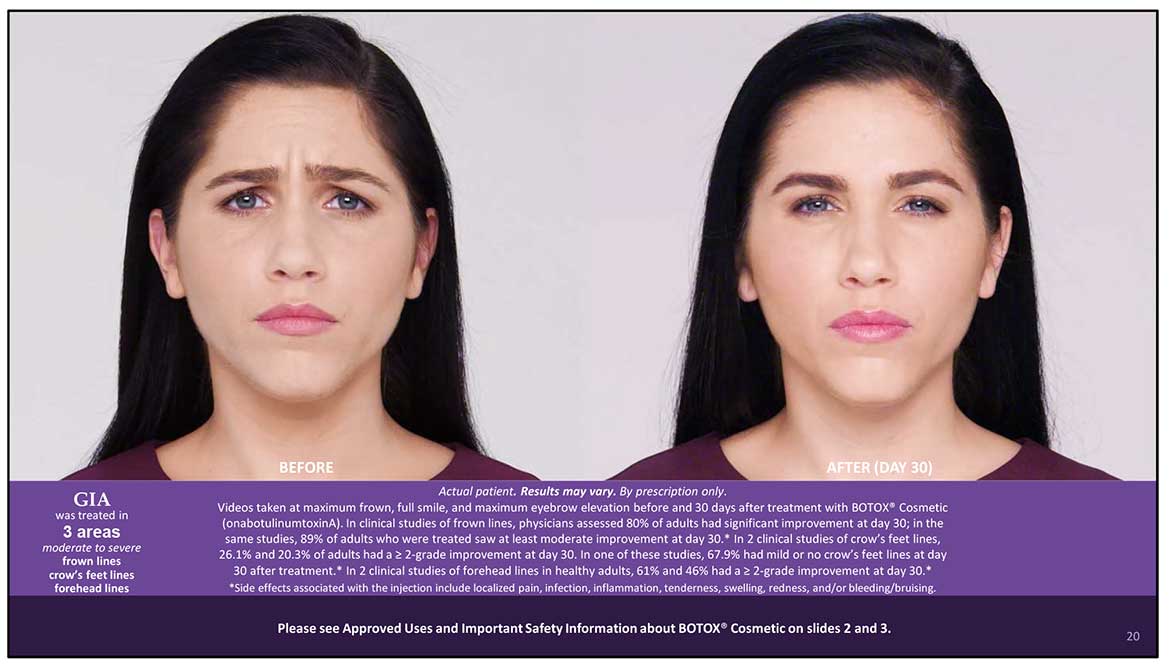 Botox Cosmetic Before and After Photos | Kingstoncosmetic.com