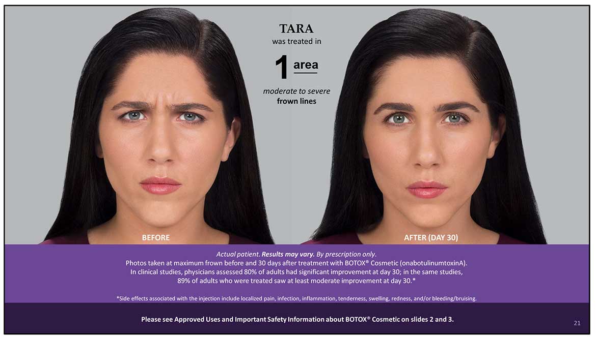 Botox Cosmetic Before and After Photos | Kingstoncosmetic.com