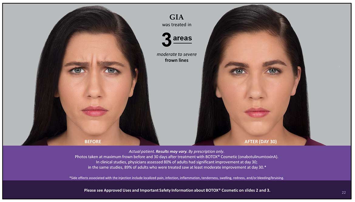 Botox Cosmetic Before and After Photos | Kingstoncosmetic.com