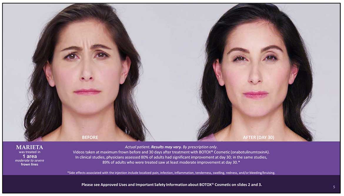 Botox Cosmetic Before and After Photos | Kingstoncosmetic.com