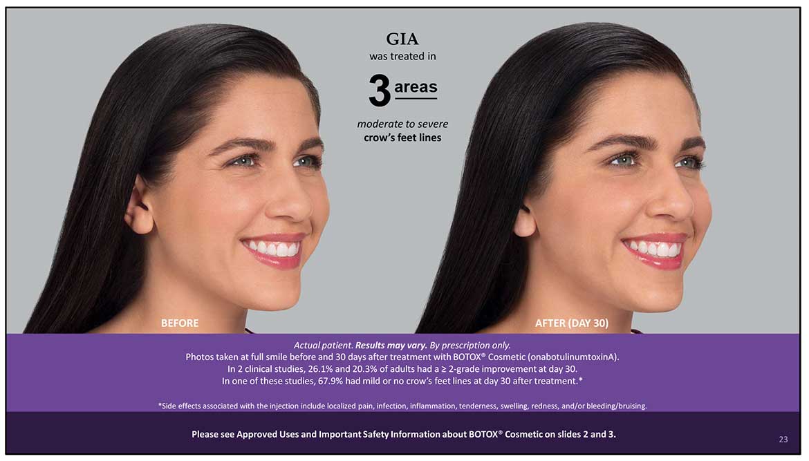 Botox Cosmetic Before and After Photos | Kingstoncosmetic.com