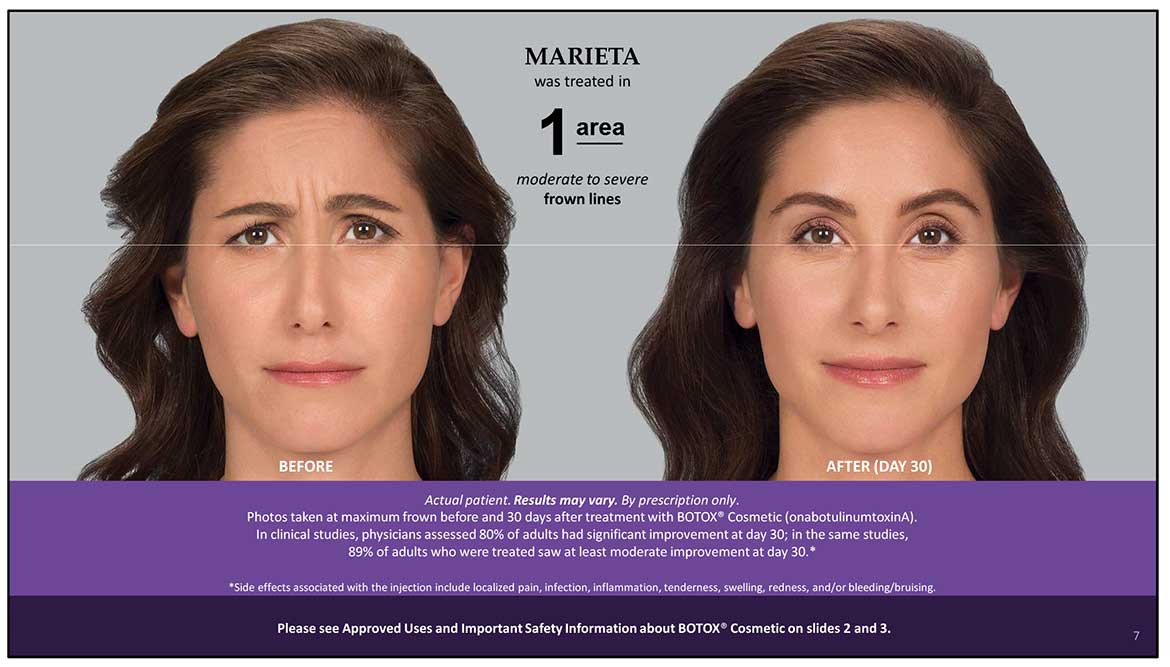 Botox Cosmetic Before and After Photos | Kingstoncosmetic.com