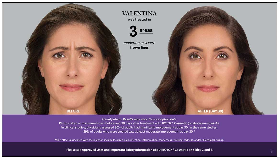 Botox Cosmetic Before and After Photos | Kingstoncosmetic.com