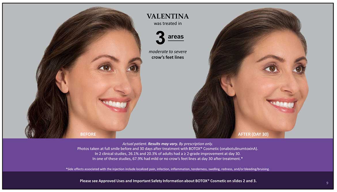 Botox Cosmetic Before and After Photos | Kingstoncosmetic.com