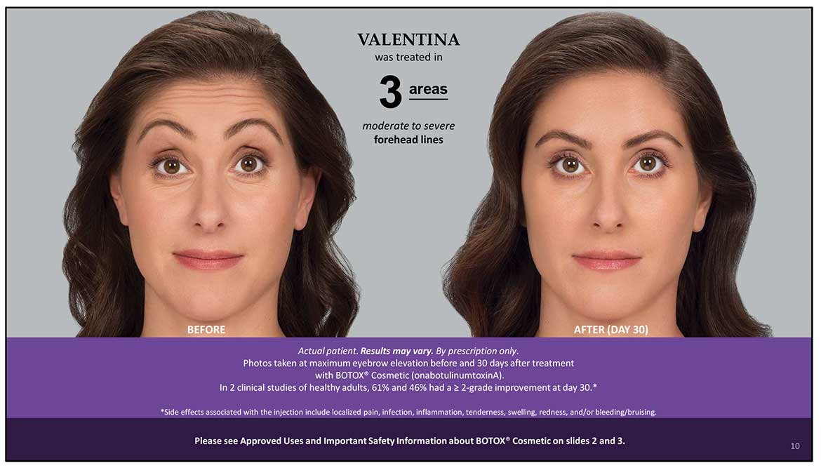 Botox Cosmetic Before and After Photos | Kingstoncosmetic.com